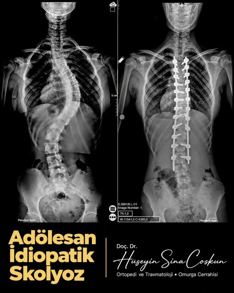 Adölesan idiopatik skolyoz: tedavi öncesi ve sonrası görüntüler