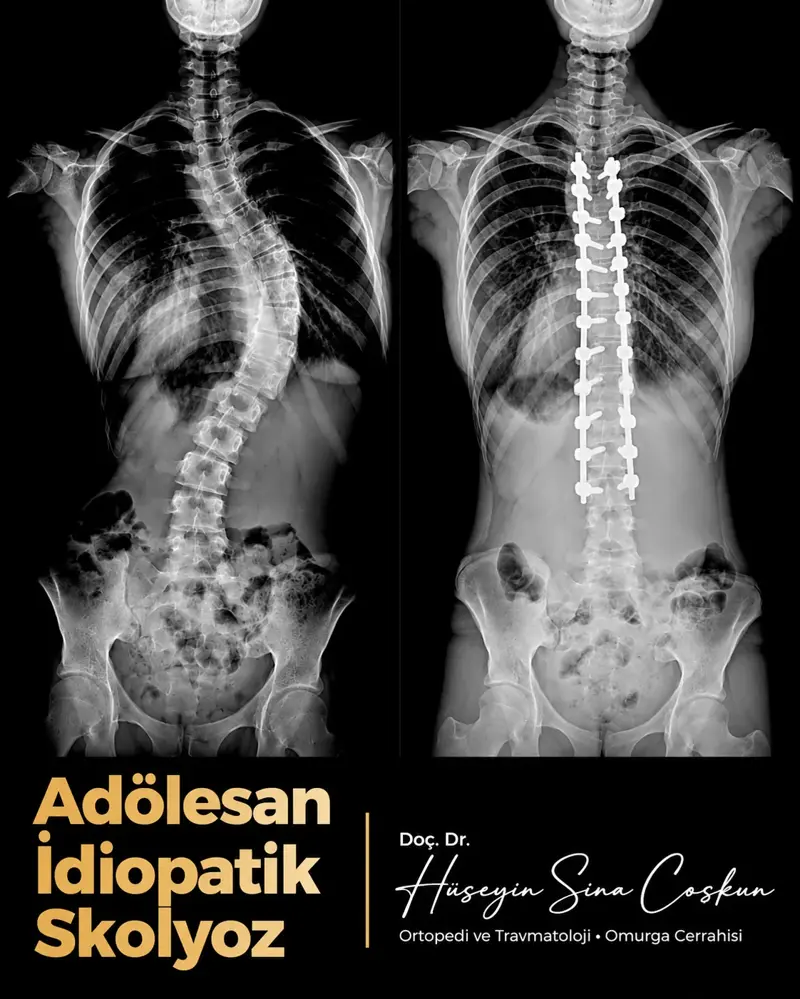 Adölesan idiopatik skolyoz: tedavi öncesi ve sonrası görüntüler