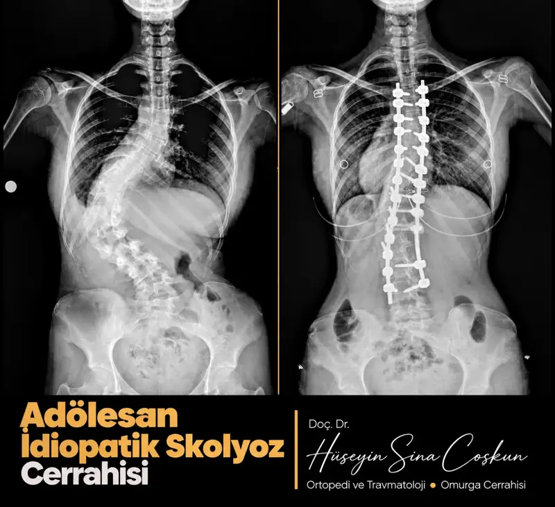 Adölesan idiopatik skolyoz cerrahisi: tedavi öncesi ve sonrası görüntüler