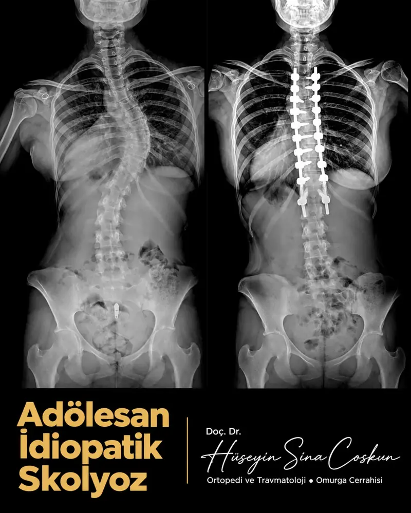 Adölesan idiopatik skolyoz: tedavi öncesi ve sonrası görüntüler