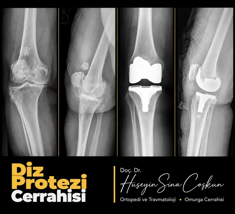 Diz protezi cerrahisi: tedavi öncesi ve sonrası görüntüler