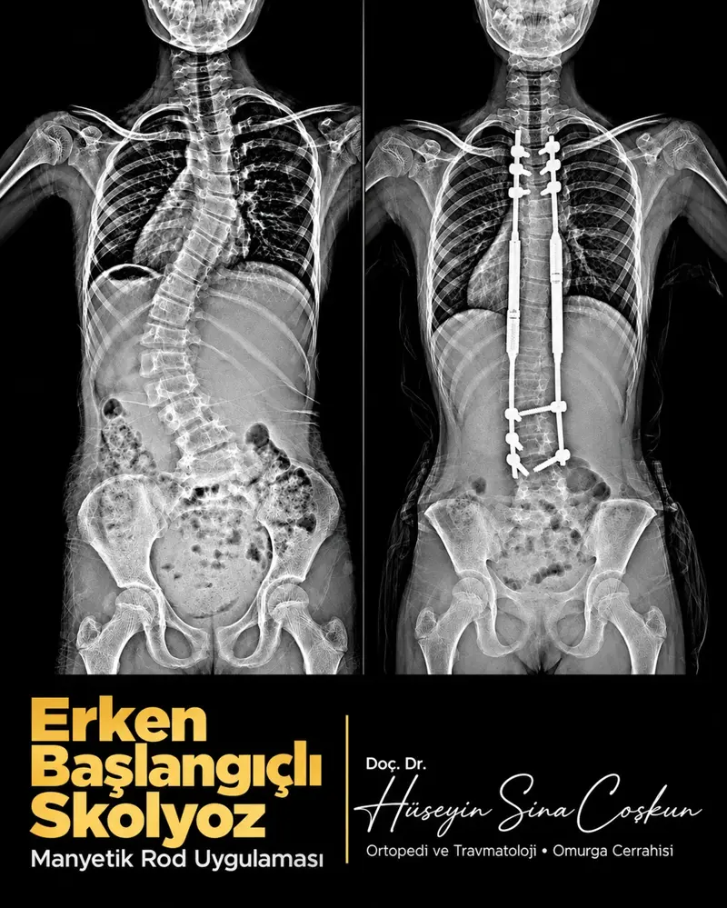 Erken başlangıçlı skolyoz: manyetik rod uygulaması: tedavi öncesi ve sonrası görüntüler