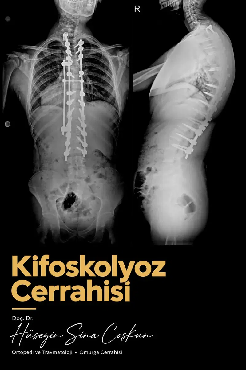 Kifoskolyoz cerrahisi: tedavi öncesi ve sonrası görüntüler