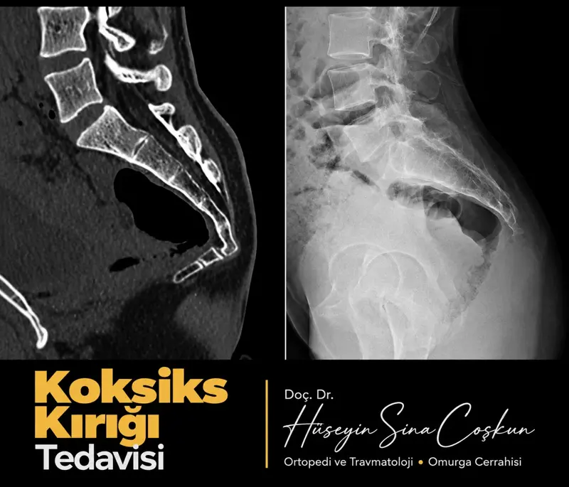 Koksiks kırığı tedavisi: tedavi öncesi ve sonrası görüntüler