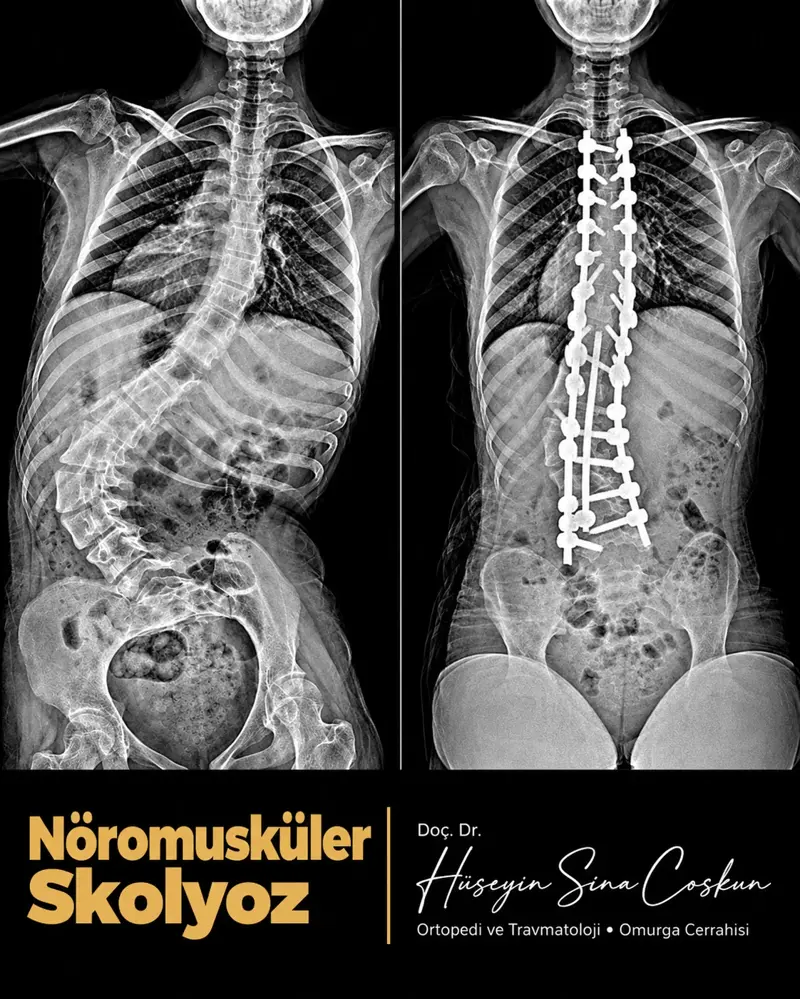 Nöromüsküler skolyoz: tedavi öncesi ve sonrası görüntüler