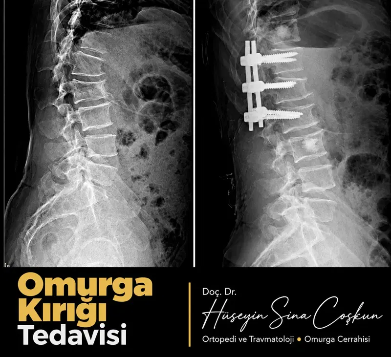 Omurga kırığı tedavisi: tedavi öncesi ve sonrası görüntüler