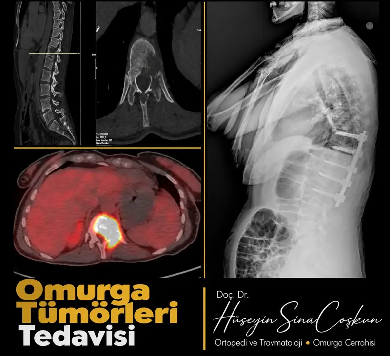 Omurga tümörleri tedavisi: tedavi öncesi ve sonrası görüntüler
