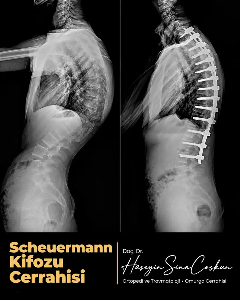 Scheuermann kifozu cerrahisi: tedavi öncesi ve sonrası görüntüler