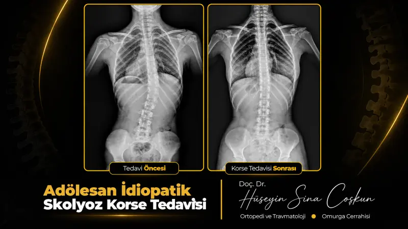 Adölesan idiopatik skolyoz: korse tedavisi: tedavi öncesi ve sonrası görüntüler