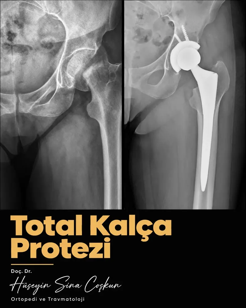 Total kalça protezi: tedavi öncesi ve sonrası görüntüler